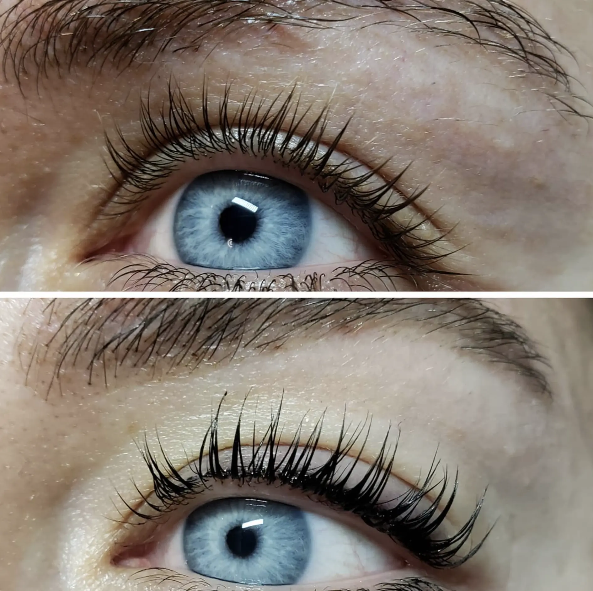 Non-surgical eye lift Melbourne