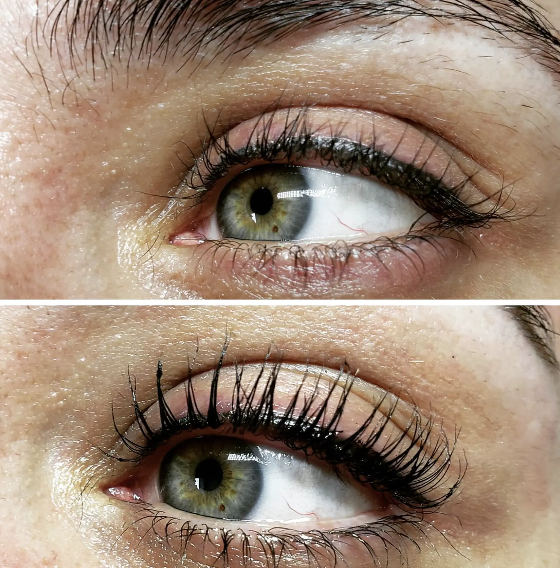 Which non-surgical eye lift works best for hooded lids?