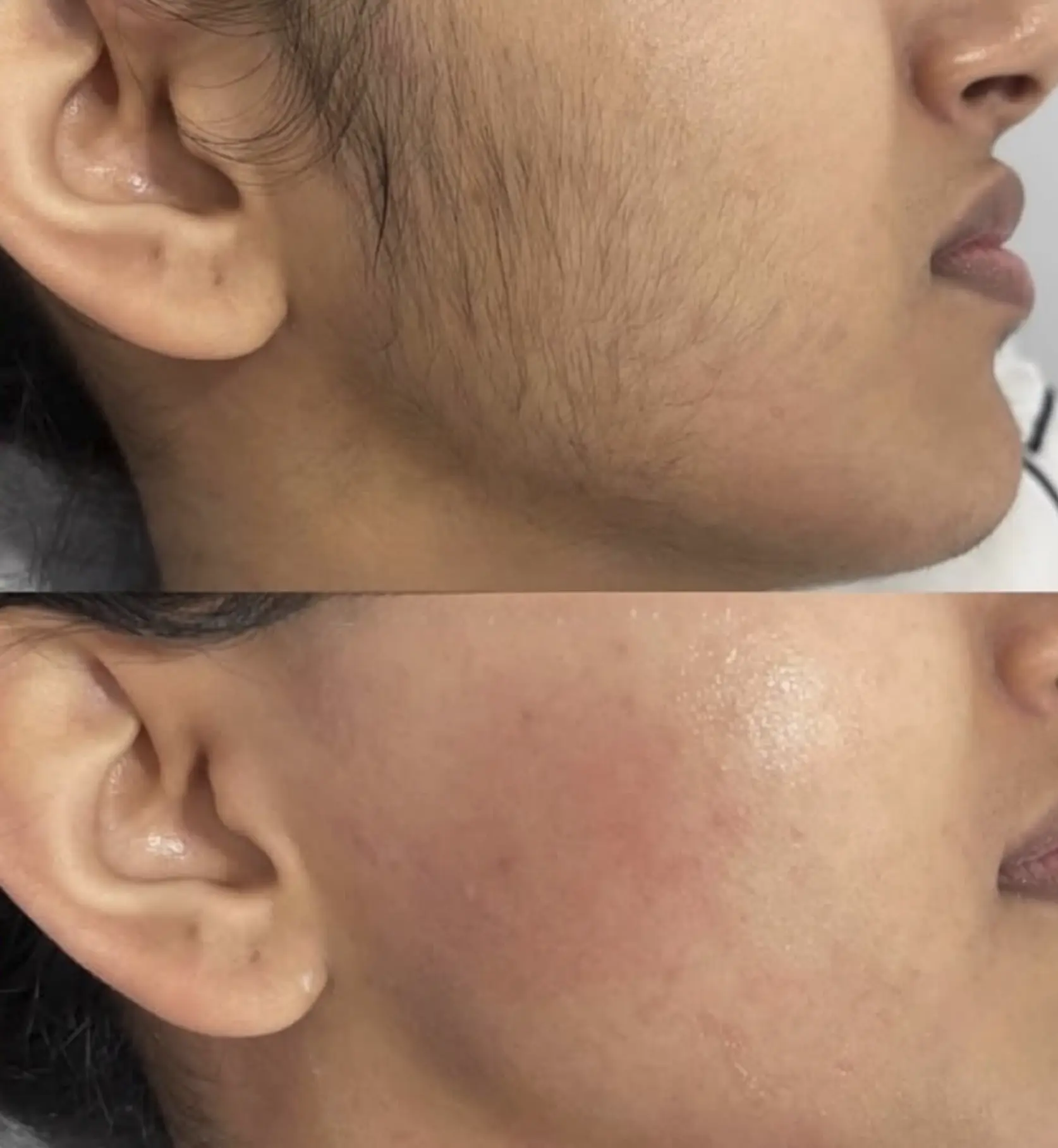 laser hair removal course cost