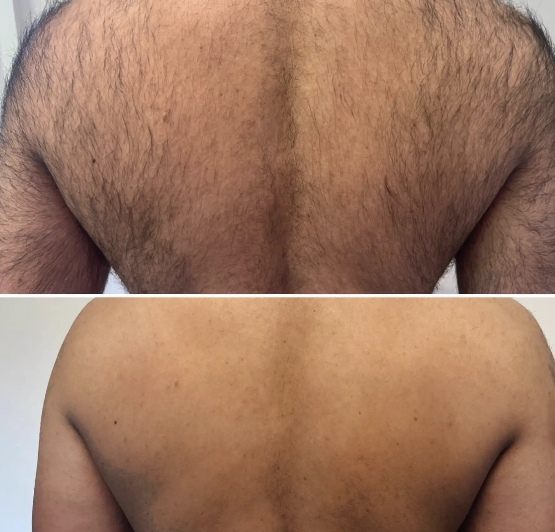 laser hair removal course nsw