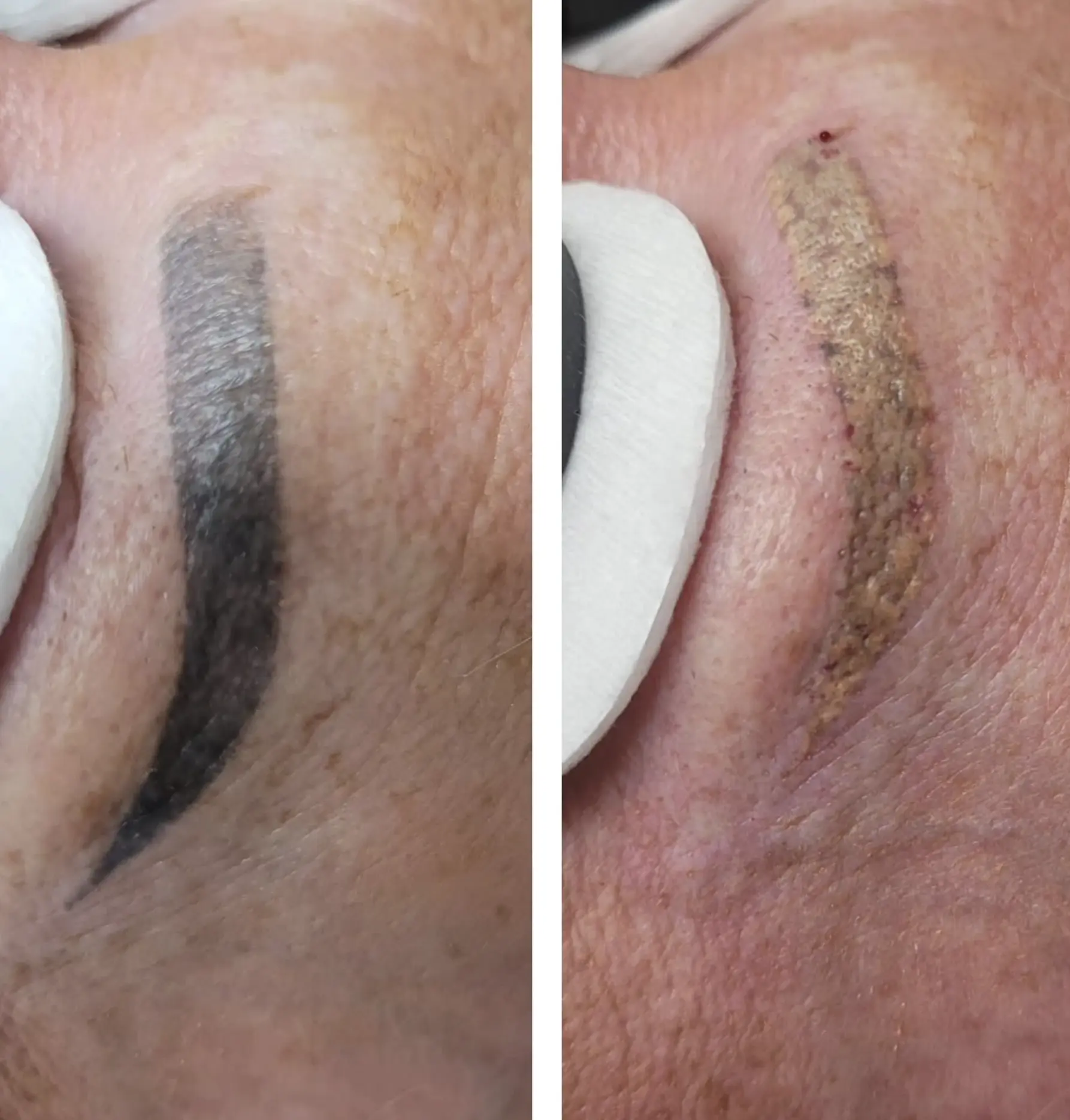 laser tattoo removal course australia