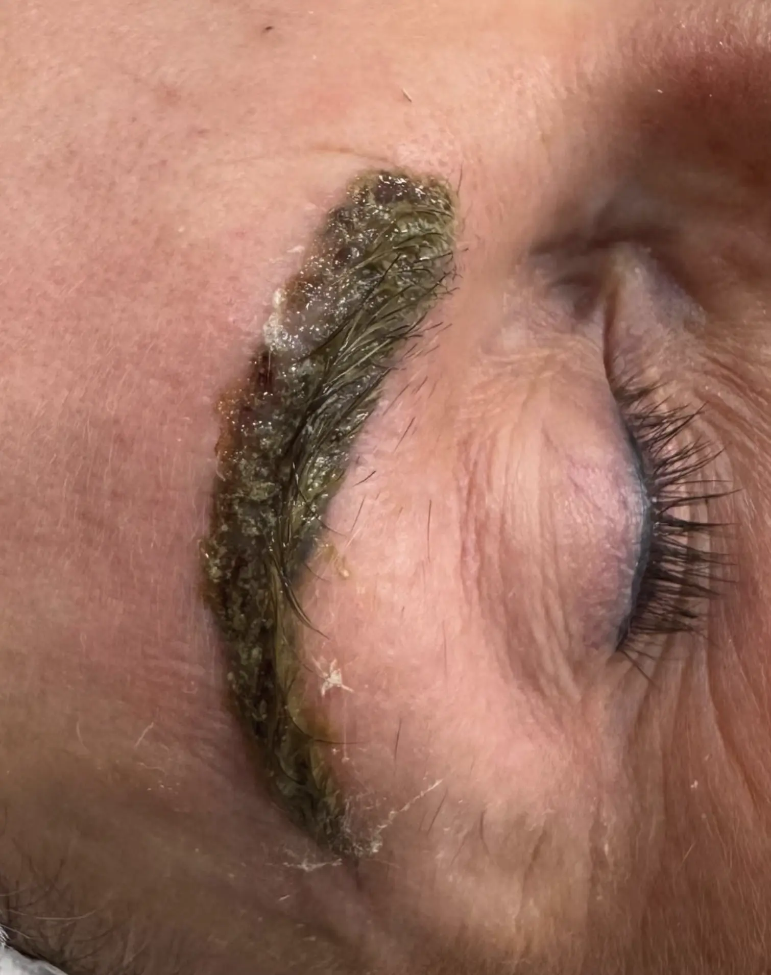 tattoo removal course nsw
