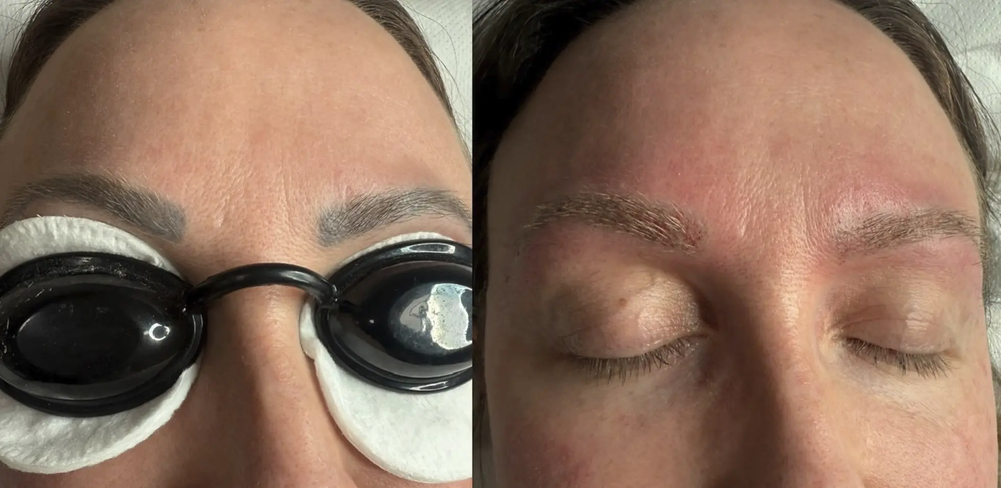 tattoo removal training course